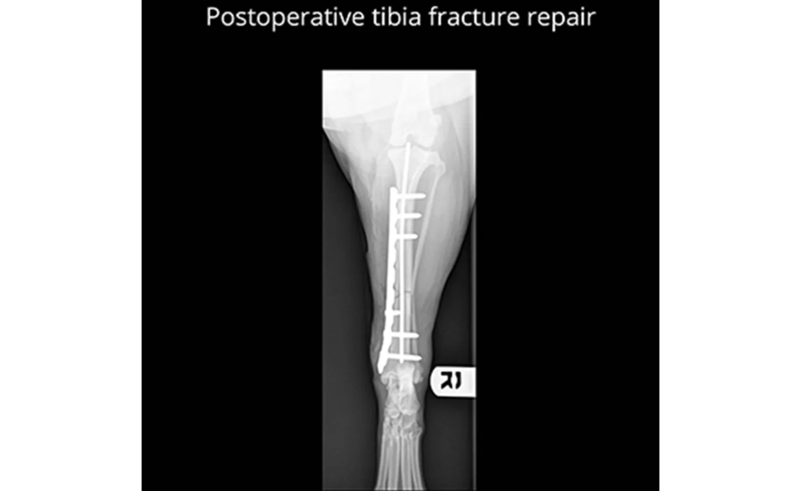Postoperative Tibia Fracture Repair X-Ray
